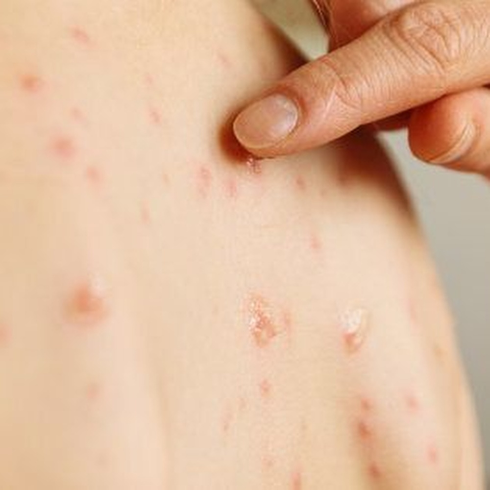 Morbillo, in tre anni un milione di casi in Europa