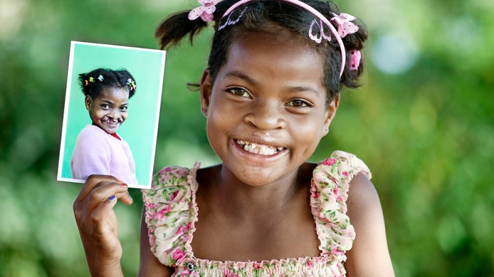 Ridare il sorriso ai bimbi che vivono nei Paesi più poveri del mondo: la storia dei medici di Operation Smile