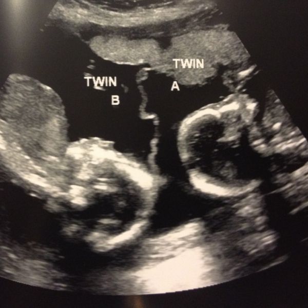 Cina, le gemelline giocano nella pancia della mamma
