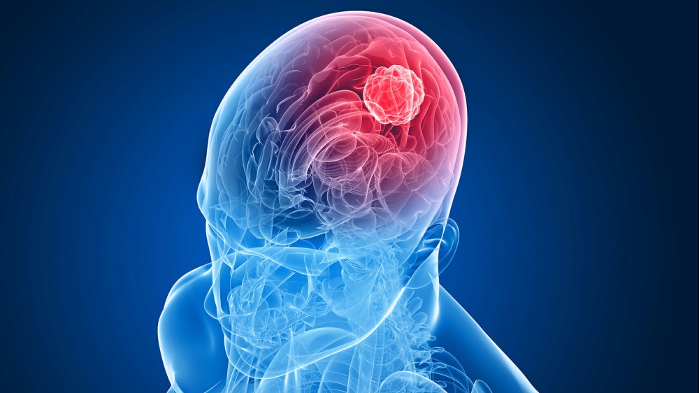 Aneurisma cerebrale: campanelli d’allarme e trattamenti 