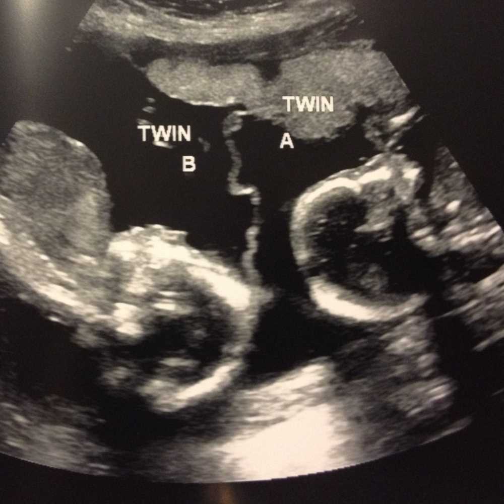 Cina, le gemelline giocano nella pancia della mamma