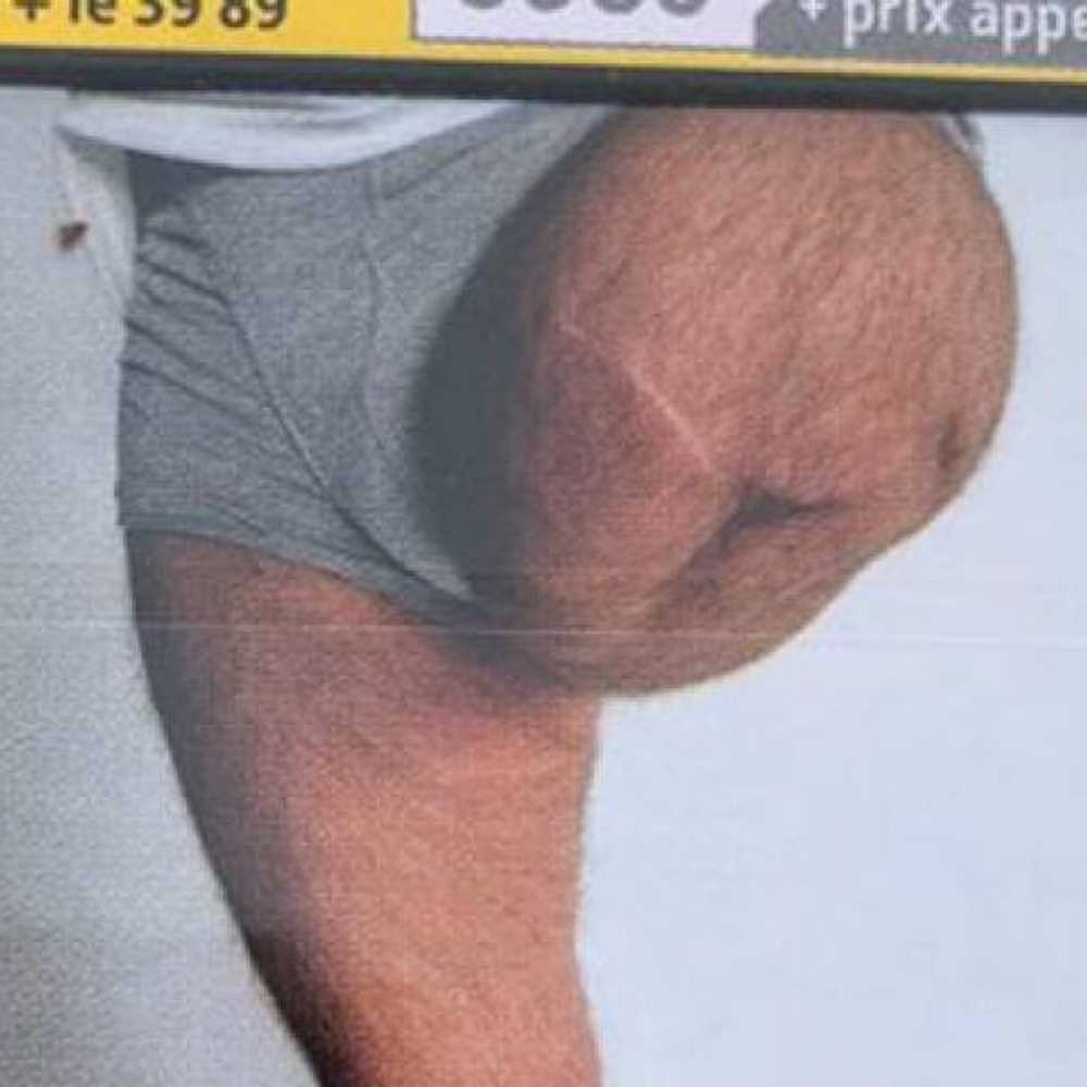 Scopre foto della sua gamba amputata sul pacchetto di sigarette