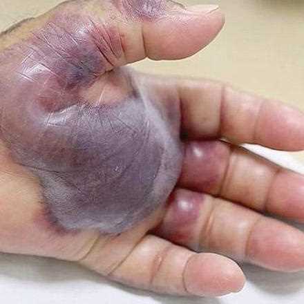 Subisce l’amputazione dell’arto dopo aver mangiato sushi