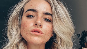 La #skinpositivity spopola su Instagram e TikTok: stop a filtri e strati di makeup